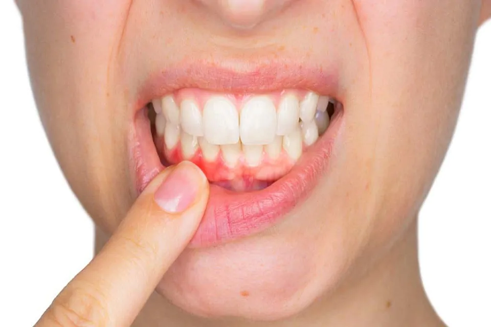 Bleeding Gums? Here Is What You Should Do